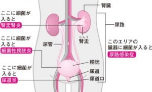 自宅でできる最高の尿路感染症治療法を簡単に見てみる
